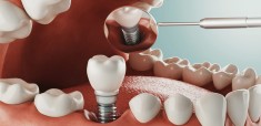 implantologia-dental